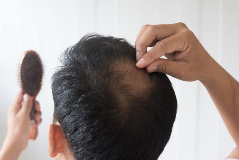 Hair Loss Myths Busted – What Works for Long-Term Growth